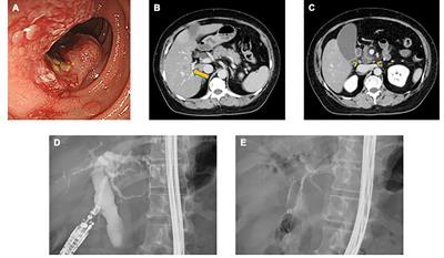 Exceptional response to alectinib for duodenal carcinoma with ALK fusion: A case report and literature review